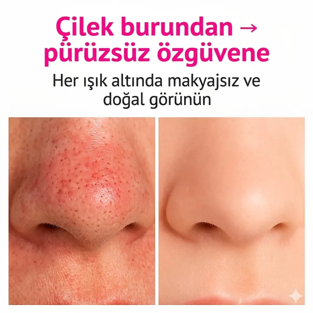 Nevoget Vakumlu Siyah Nokta Temizleme Cihazı